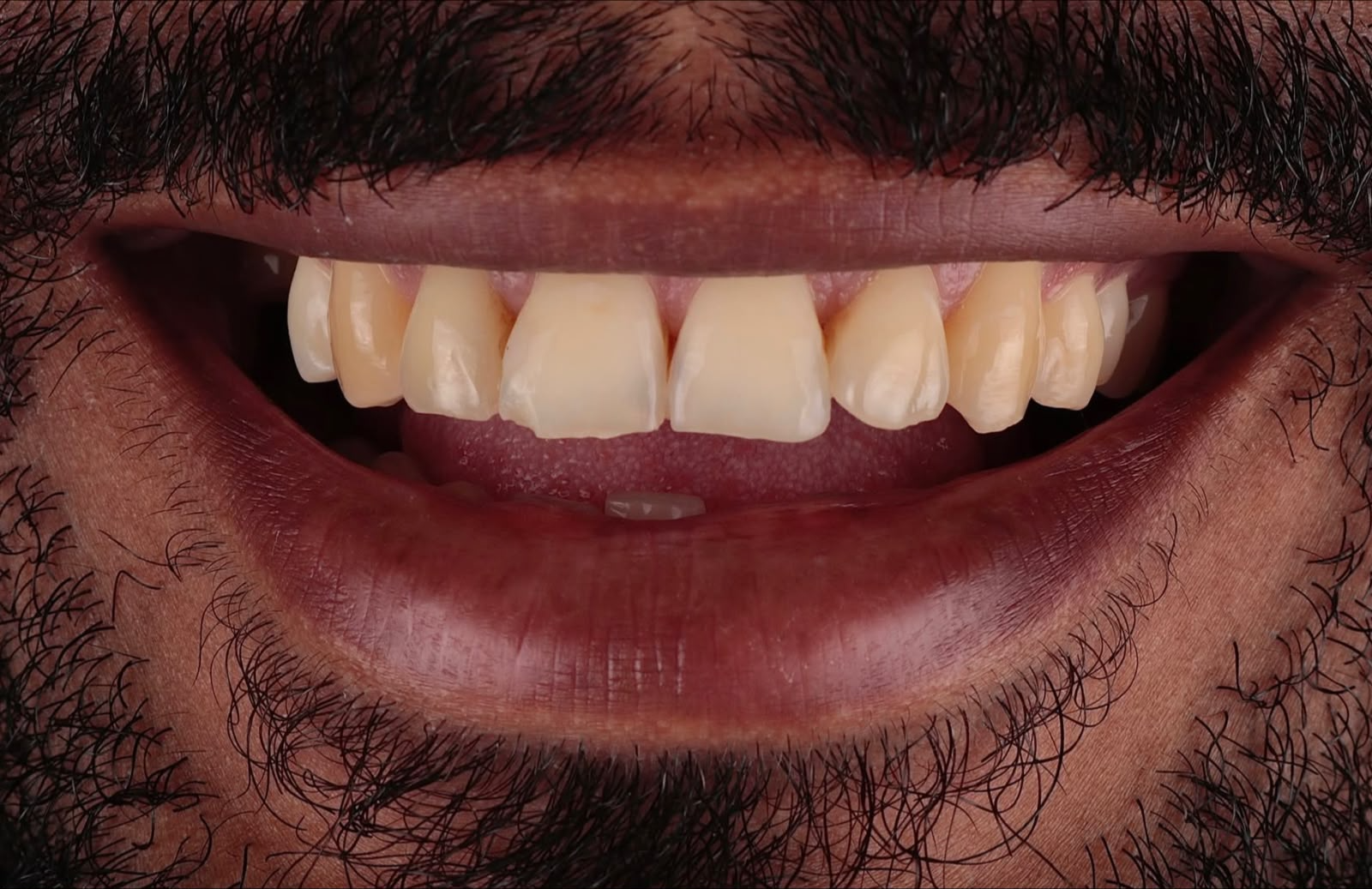 Sorriso antes do tratamento com facetas em resina
